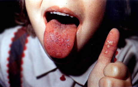 pictures of hand foot and mouth disease rash